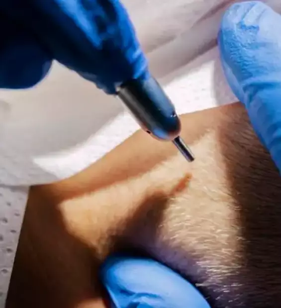 Dermopigmentation capillaire homme