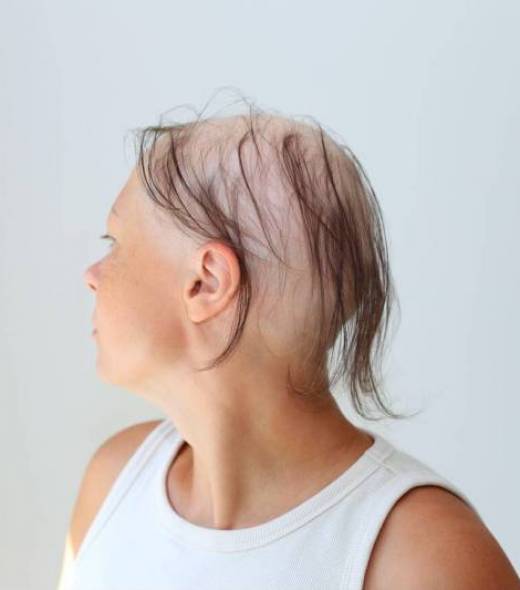 alopecie frontale fibrosante (2)