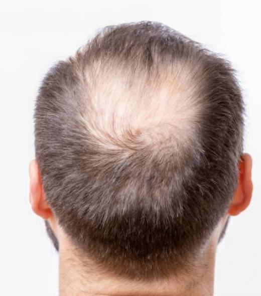 alopecie homme