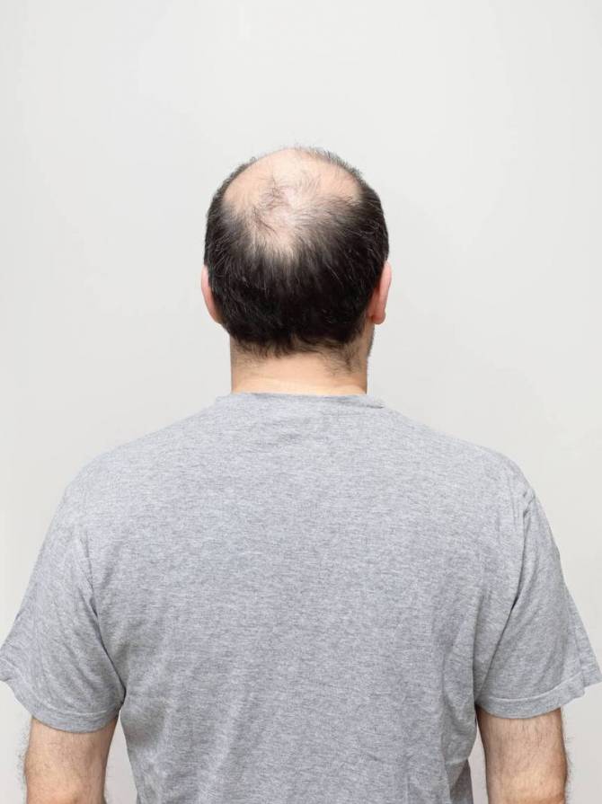 alopecie homme cause