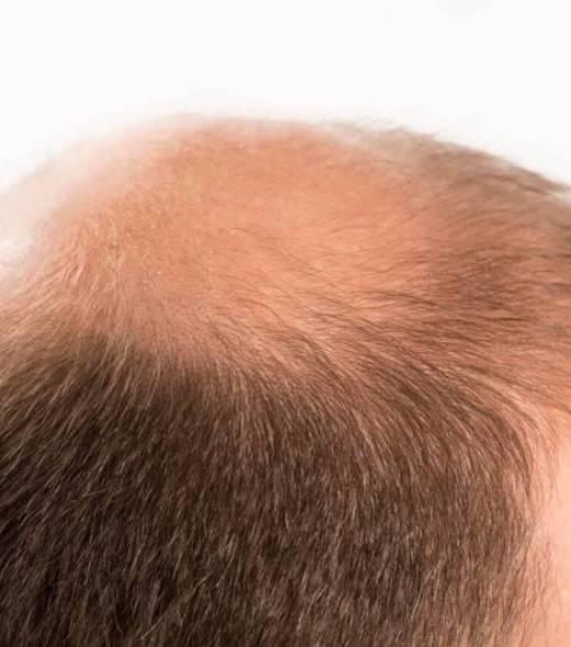 calvitie-diffuse-homme calvitie-diffuse-homme