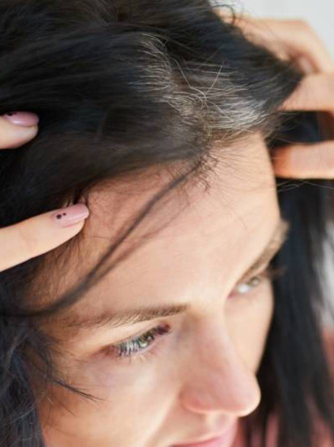 cause alopecie frontale fibrosante cause alopecie frontale fibrosante