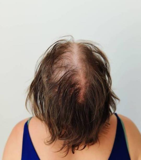 definition alopecie frontale fibrosante